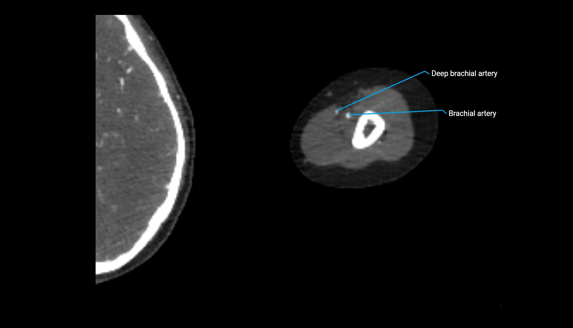 CTA upper limb axial cross sectional anatomy labelled image 247 (2).webp